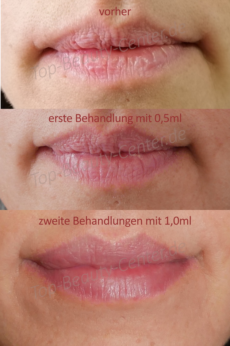 Lippen Aufspritzen Und Faltenunterspritzung Ohne Nadel Schon Ab 99