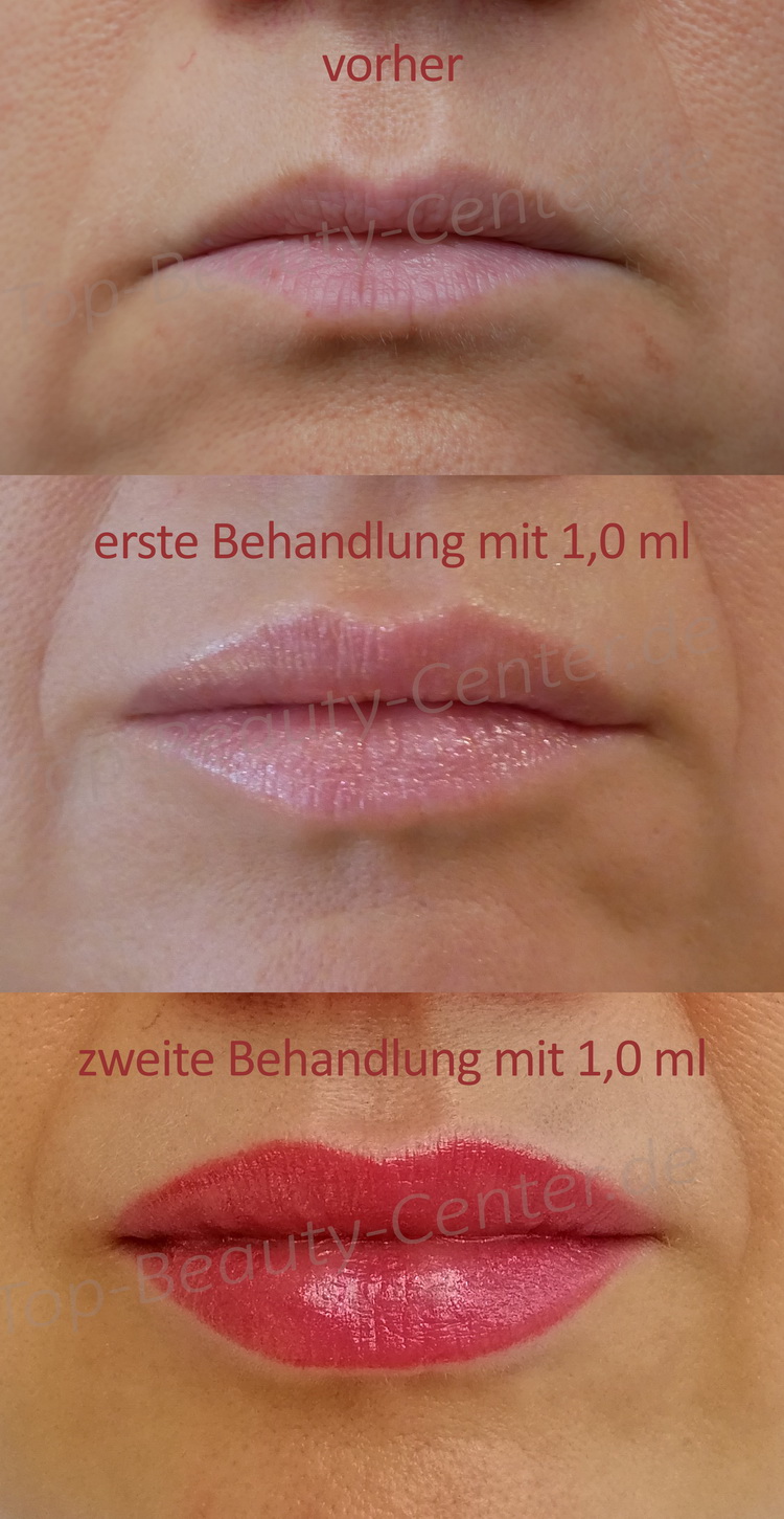 Lippen Aufspritzen Und Faltenunterspritzung Ohne Nadel Schon Ab 99