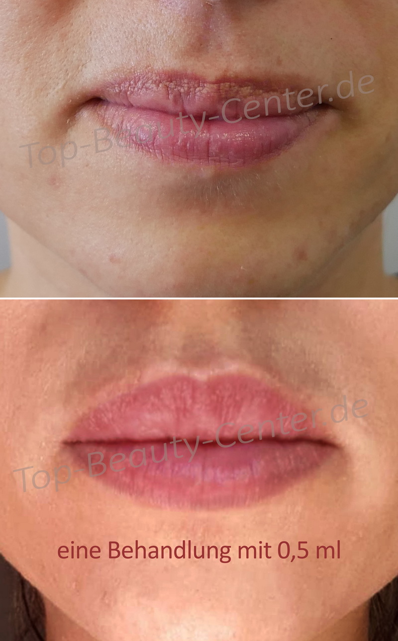 Lippen Aufspritzen Und Faltenunterspritzung Ohne Nadel Schon Ab 99